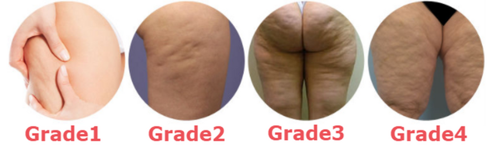 Grades & Types Of Cellulite | Chrysalis