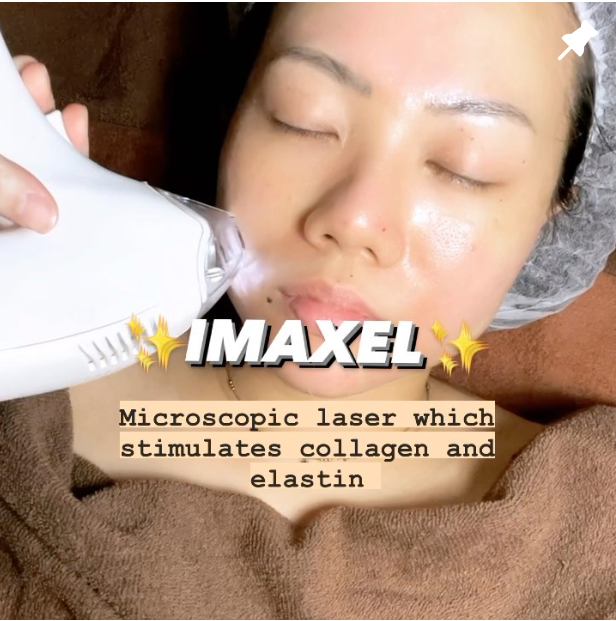 IMAXEL Laser Treatment for Acne & Scars | Chrysalis