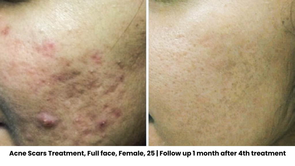 Acne Scar Before After Treatment | Chrysalis