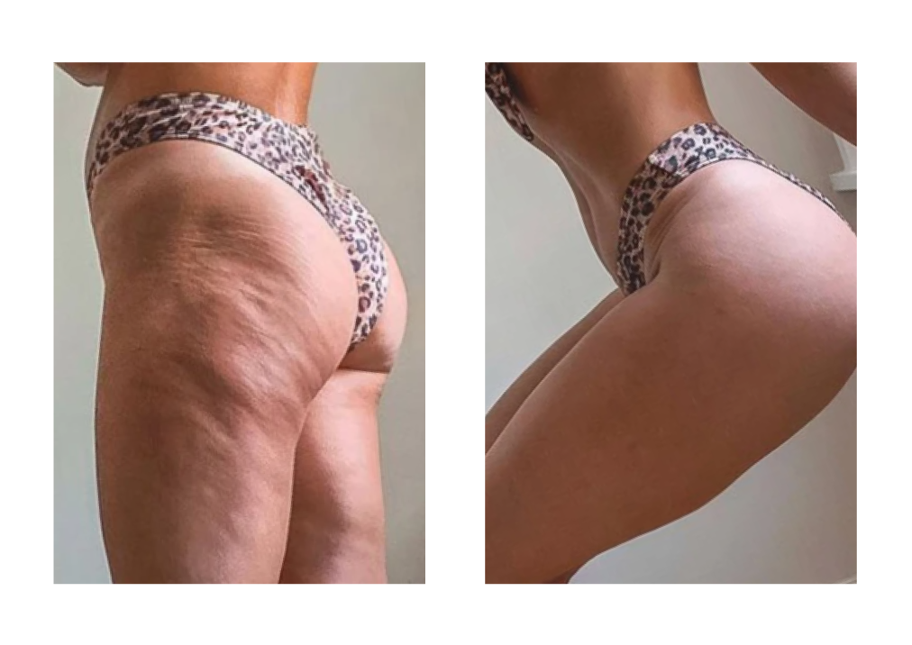 Before & After Cellulite Treatment | Chrysalis