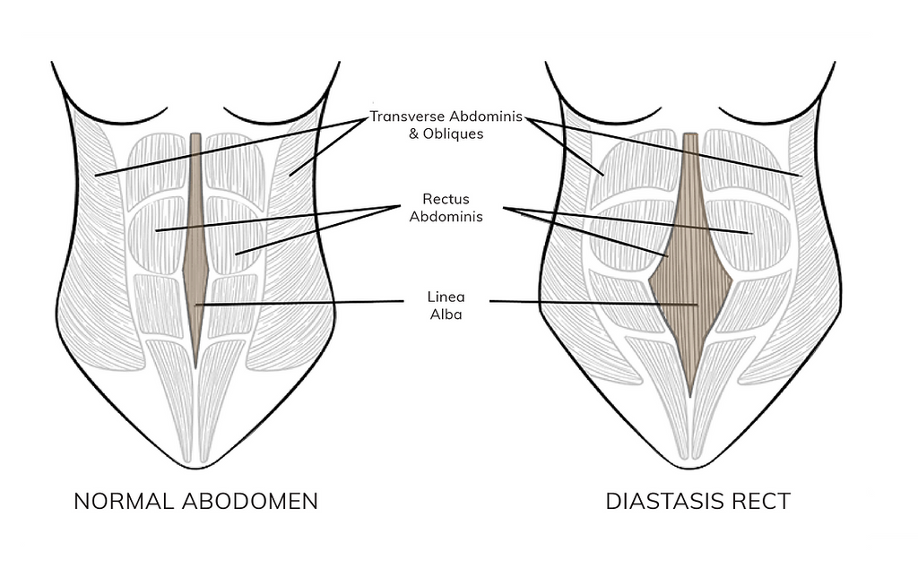 Diastasis Recti | Chrysalis