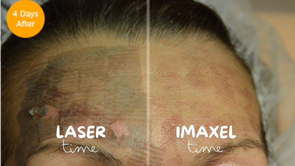 Laser Vs IMAXEL Acne Scar Treatment