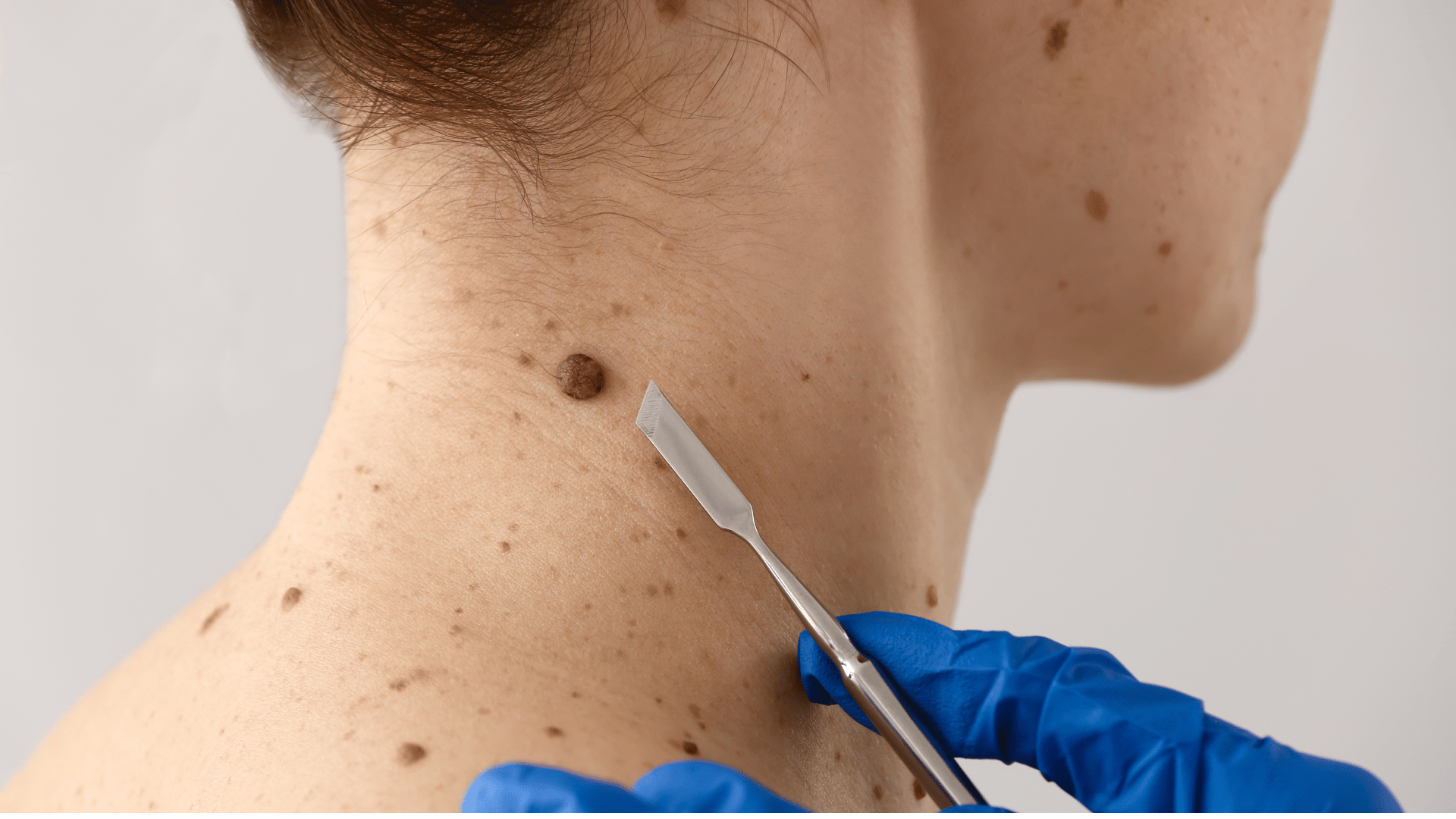 Affordable Skin Tag Removal in Singapore
