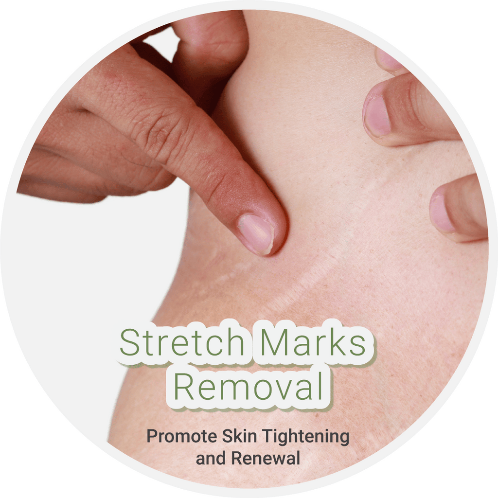 Stretch Mark Removal | Chrysalis