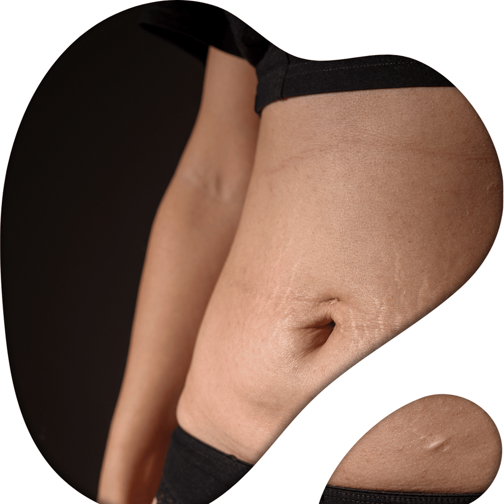 Stretch Marks Removal Treatment | Chrysalis