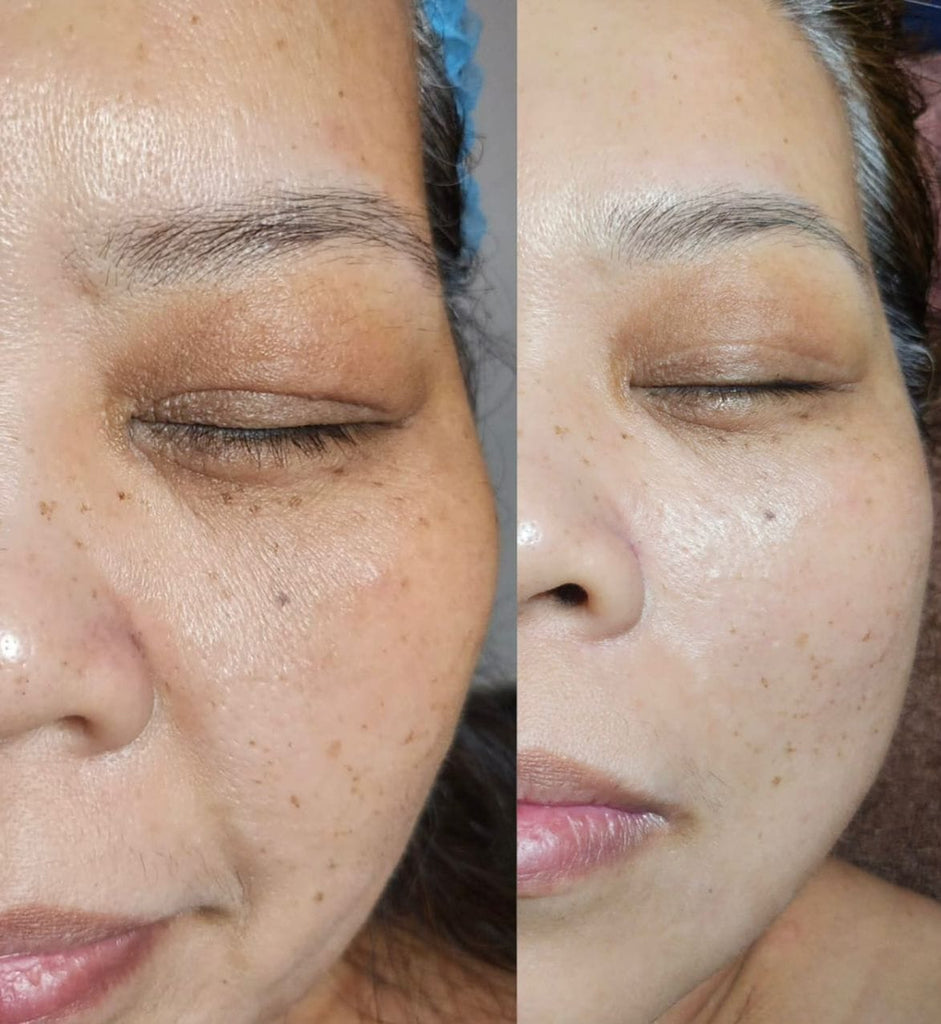 Plasma Facial Treatment Before And After | Chrysalis