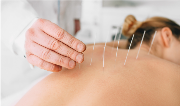 Acupuncture Singapore | Chrysalis