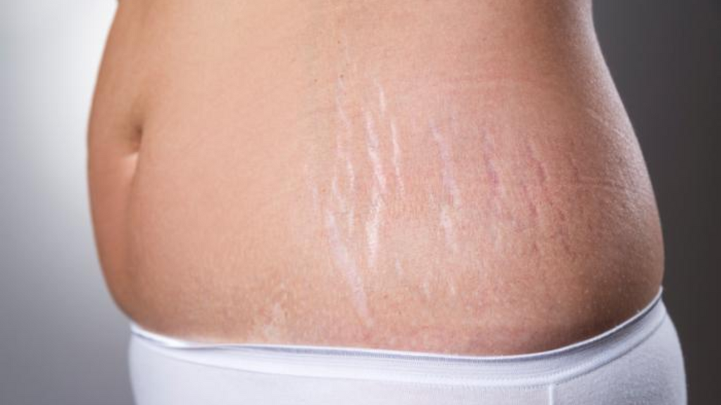 stretch mark singapore